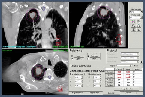 肺がんに対する治療計画画像